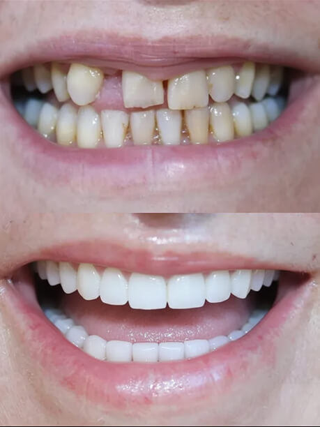 Before-and-after image of a smile transformation, showcasing significant whitening and alignment improvement in teeth.