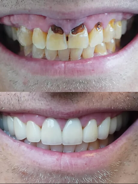 Before and after dental treatment: the top image shows discolored, damaged teeth, while the bottom features a bright, healthy smile.