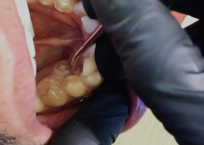A close-up of a gloved hand using a dental tool to examine a patient's mouth and teeth for oral care.