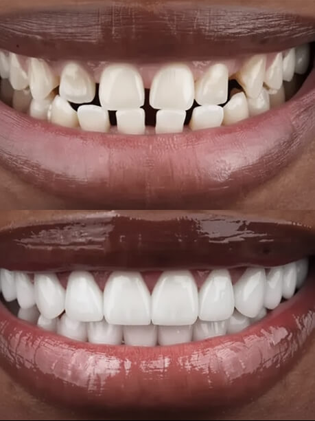 Before and after split image showing a person's smile with crooked, gapped teeth above and perfectly aligned, bright white veneers below.