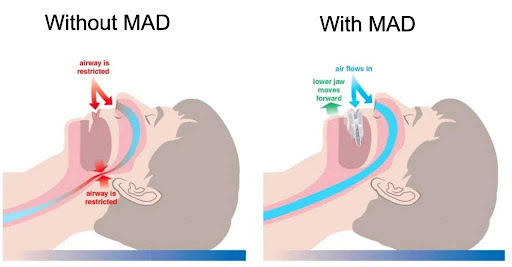 Diagram comparing restricted airways without a Mandibular Advancement Device (MAD) to improved airflow with a MAD that moves the lower jaw forward.